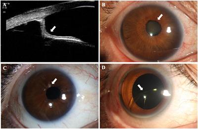 Biometric and Structural Ocular Manifestations of Anterior Megalophthalmos